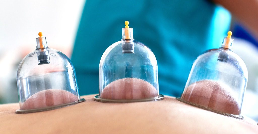 Hijama Cupping