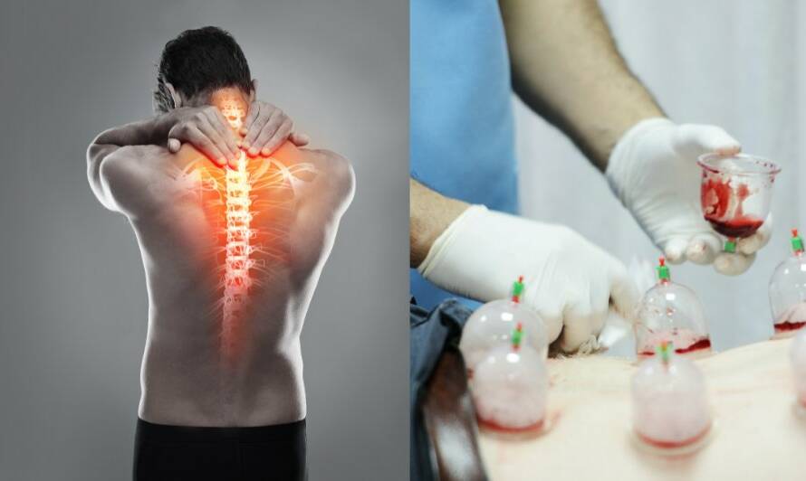 Hijama Cupping Therapy For Back Pain