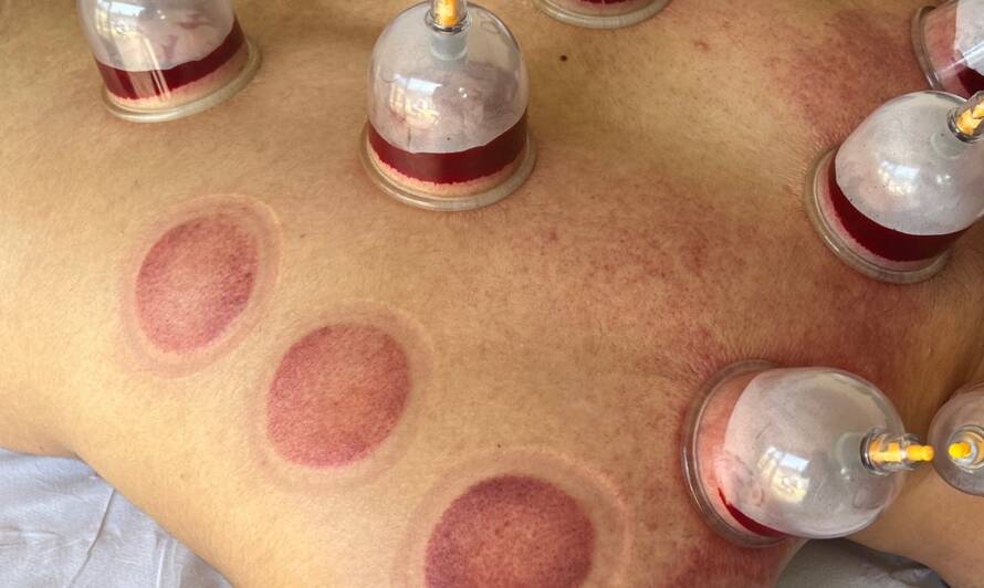 HEALING POWER OF HIJAMA AND CUPPING THERAPY IN ST ALBANS