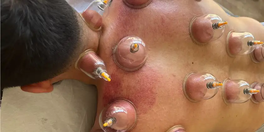 Creating a Synergy of Health and Peace with Hijama Cupping for Anxiety