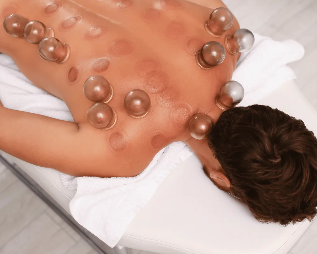Dry cupping across the back during a recovery session